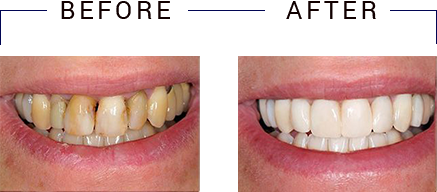 The image shows a person s teeth before and after dental treatment, with the after image showing an improvement in oral hygiene.