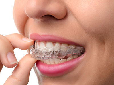 The image shows a person with a clear aligner on their teeth, holding it up to their mouth as if examining it closely.