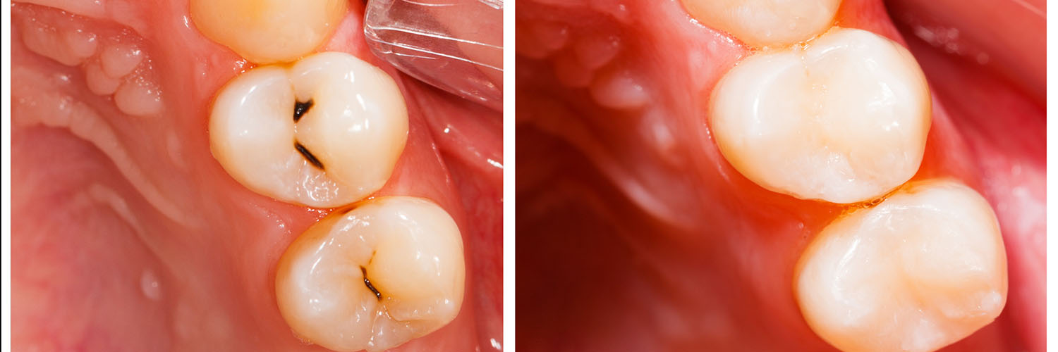 The image shows a close-up view of a human mouth with teeth, gums, and a tongue, displaying a dental implant and possibly other oral health procedures.