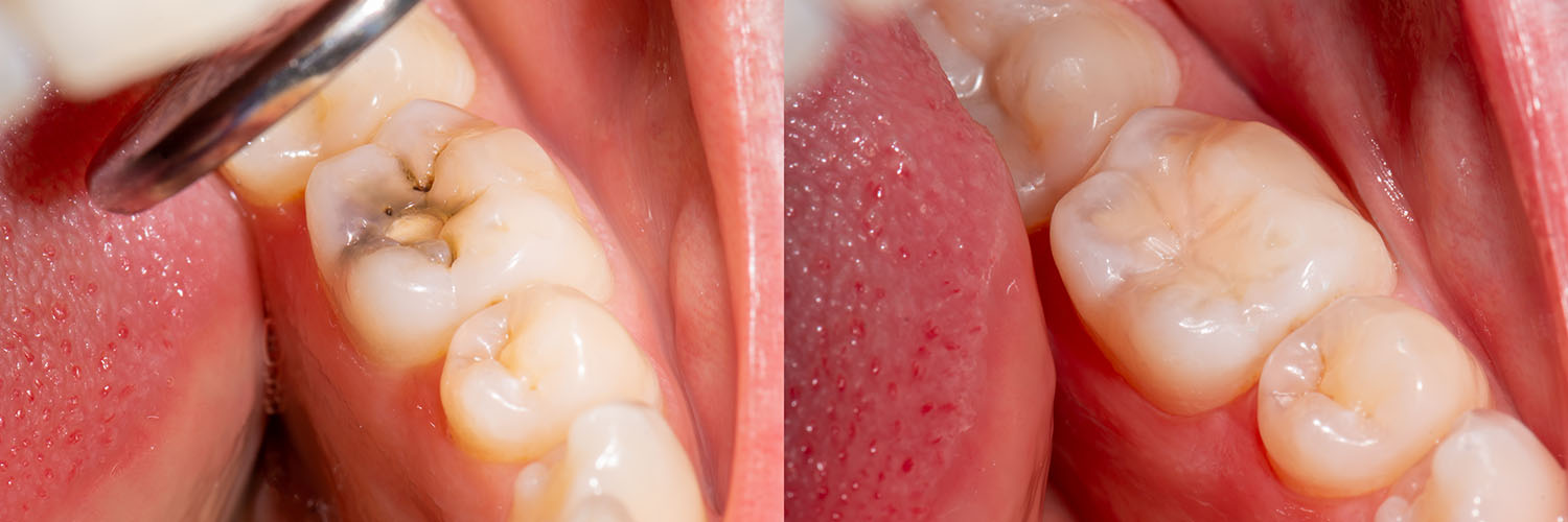 The image shows a close-up view of an oral cavity with multiple teeth, some of which appear to be decayed or damaged, with visible plaque and stains on the teeth, and the presence of a dental tool that may be used for cleaning or repairing the teeth.