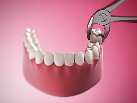 The image shows a pair of scissors with a red handle being used to remove a tooth from a dental model featuring a set of white teeth within a simulated mouth, with a pink background.