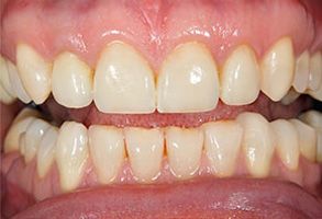 The image shows a close-up view of a person s teeth with visible staining and discoloration, emphasizing the need for dental care and hygiene.