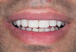 The image shows a close-up of a person s smiling mouth with teeth, featuring white fillings on the front teeth.
