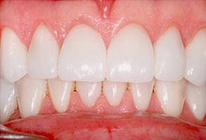 The image shows a close-up view of a person s teeth with an emphasis on their white color and cleanliness, set against a red background that highlights the dental work.