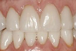 This image features a close-up view of a person s teeth with a focus on a dental implant, showcasing the appearance of the implant in comparison to natural teeth.