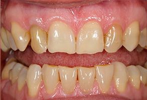 This is a composite image featuring two photographs of an individual s teeth showing significant decay and discoloration, with a focus on dental health concerns.
