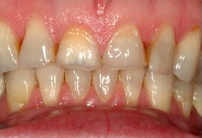 The image shows a close-up view of a person s teeth with yellow stains, indicating a condition that may require dental care.