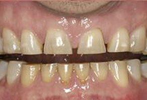 The image shows a close-up view of a person s mouth with yellowed teeth and a black metal wire across them, suggesting dental work or treatment has been completed.