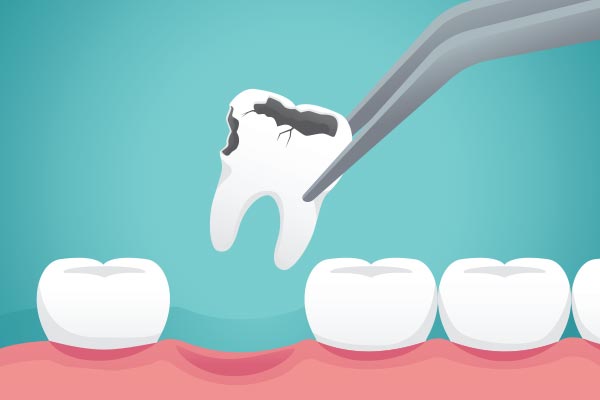 Ask a General Dentist: What Happens to Your Tooth After Extraction from Diamond Head Dental Care in Pearl City, HI