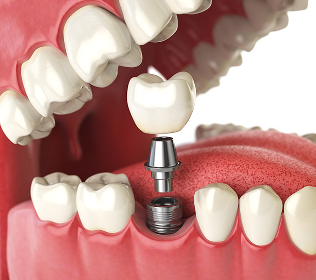 Pearl City Will I Need a Bone Graft for Dental Implants