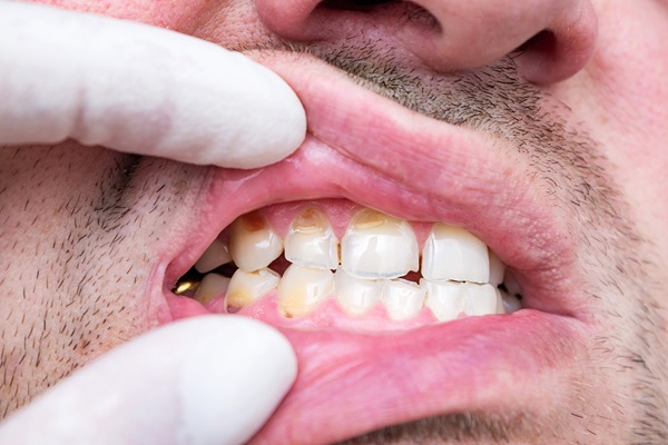 How A General Dentist Can Treat A Chipped Tooth