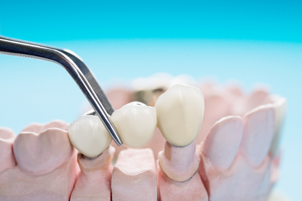 When Is A Dental Bridge Recommended To Replace Missing Teeth?