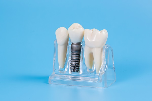 Understanding Dental Crowns Versus Veneers