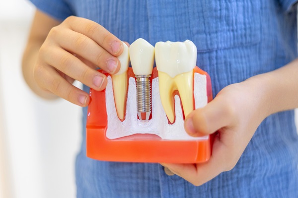 Reasons Why You Should Consider Getting Dental Implants