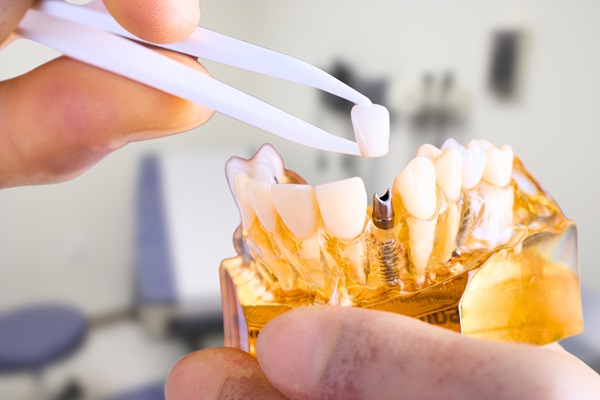 Foods You Should Avoid With Dental Implants