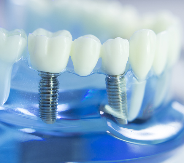 Pearl City Dental Implants