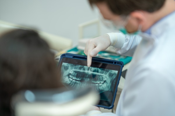 Common Reasons For Root Canal Therapy