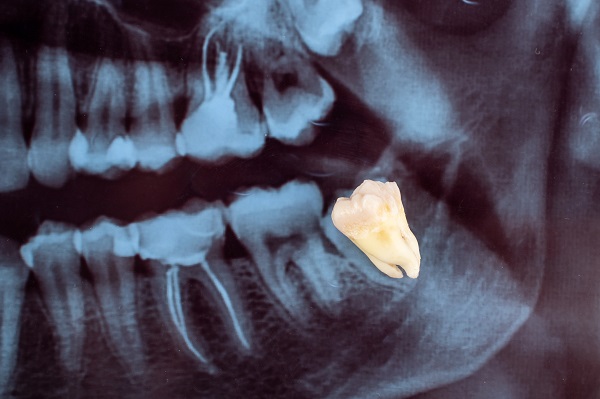 Wisdom Tooth Extraction:  Is It Painful?